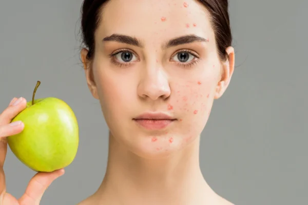 Can food cause acne?